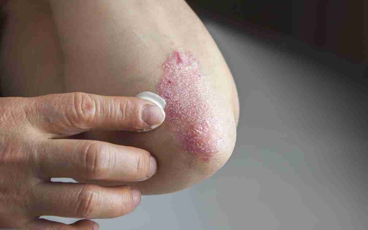 Migliore crema per aiutare la psoriasi di viso, mani e gomiti