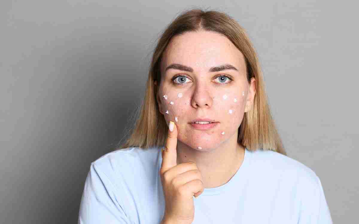 Crema per acne ormonale e giovanile: scopri il potere naturale