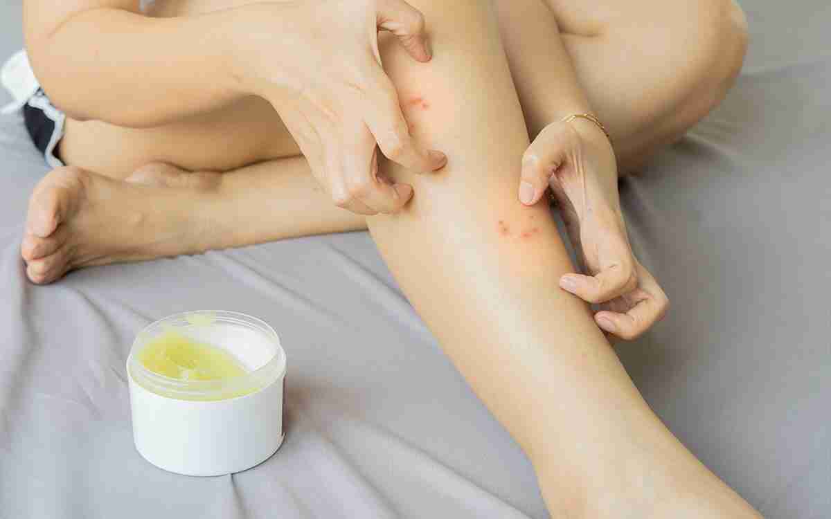 Crema antiprurito naturale: il sollievo che viene dalla natura